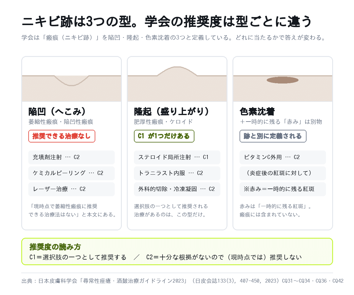 ニキビ跡の3つの型(陥凹・隆起・色素沈着)と日本皮膚科学会ガイドラインの推奨度